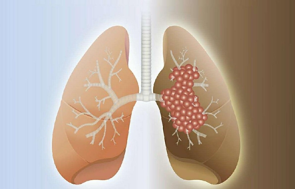 郑州哪家中医治疗肿瘤好？